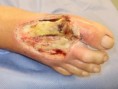 /album/galeria-de-fotos/infec%c3%a7%c3%a3o%20grave%20em%20paciente%20com%20oclus%c3%a3o%20arterial%20troncular%20proximal-%20observar%2c%20apos%20o%20debridamento%20inicial%2c%20a%20palidez%20da%20musculatura%20e%20a%20necrose%20de%20tecidos%20profundos-jpg/